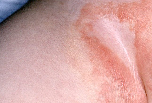 क्योँ होता है शिशु को डायपर से रैशेस (Nappy Rash)